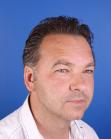 After Hair Transplant&nbsp;Temporal Hairline